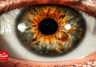 طراحی یک برنامه برای تشخیص خشکی چشم