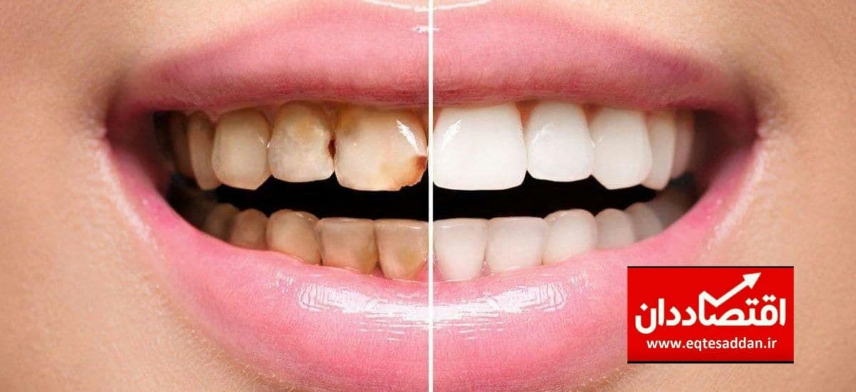 چگونه میشود دندانهای سفید داشته باشم ؟